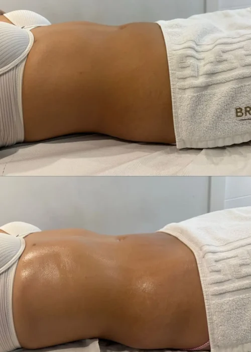 Antes y Después 2 Brilen reduit - Masajista gijón